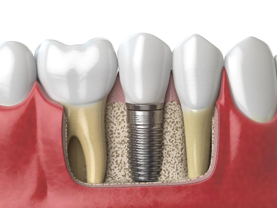 close up of dental implant | dental implants st paul mn