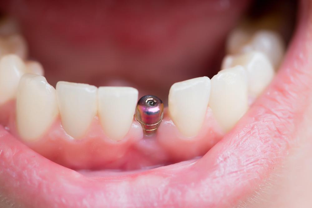 close up of dental implant in jaw | dental implants st paul mn