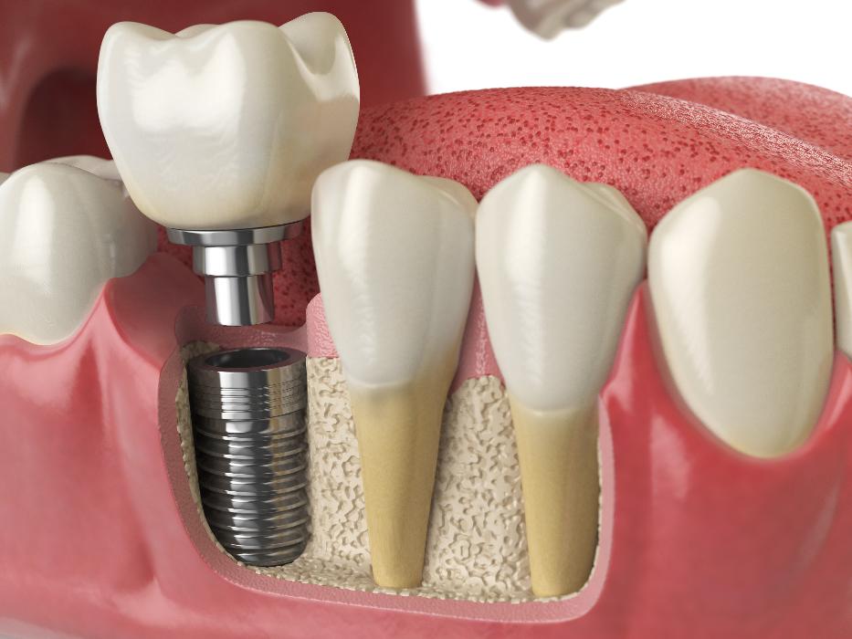 close up of dental implant | dental implants st paul mn
