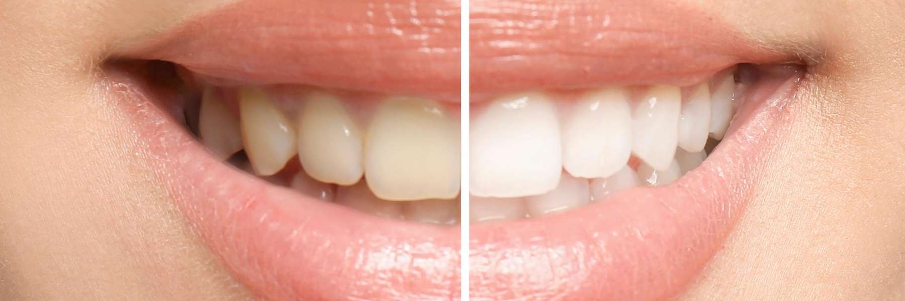 Before and after image of teeth using teeth whitening, saint-paul mn