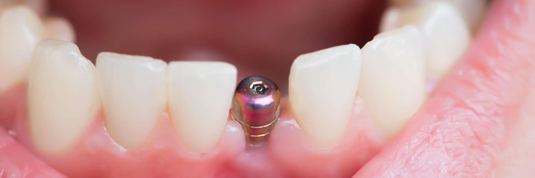 close up of dental implant | family dentist st paul mn