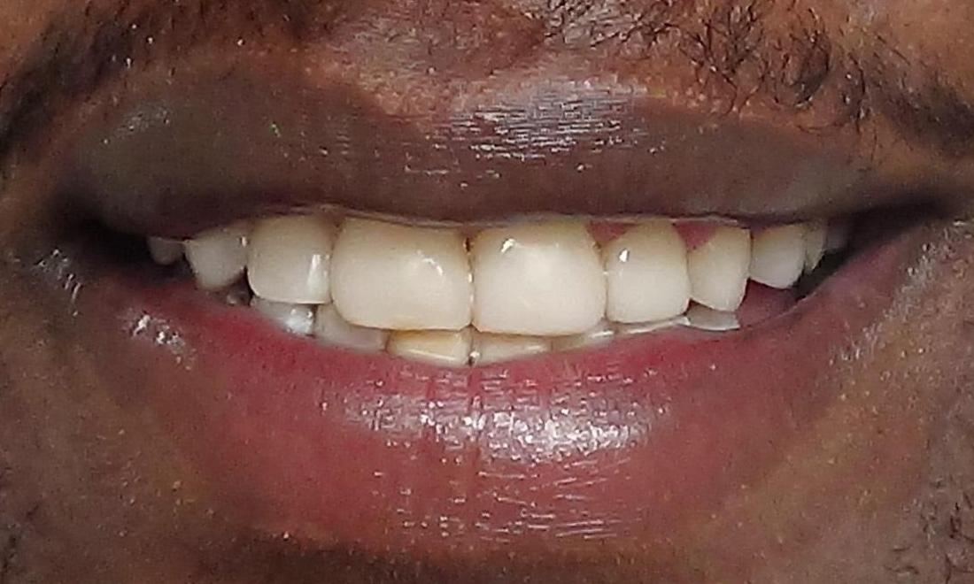 St Paul MN Cosmetic Bonding Before & After Photos Highgrove Dental Care