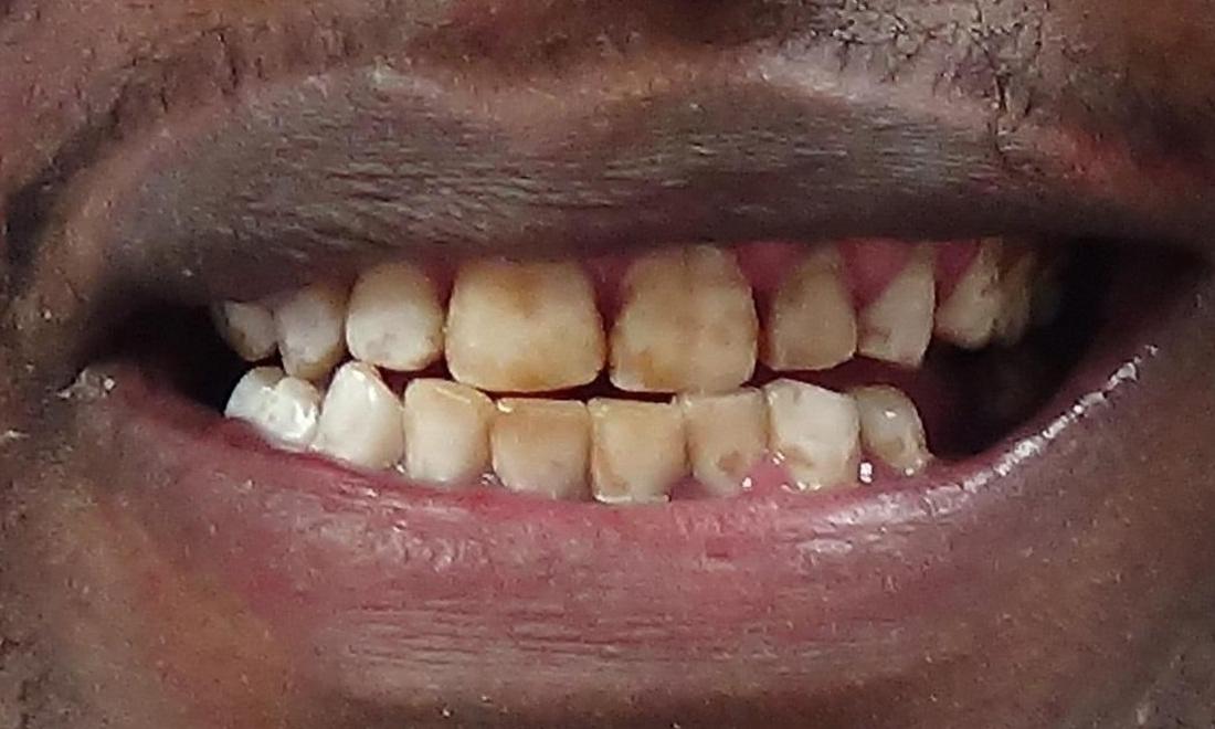 St Paul MN Cosmetic Bonding Before & After Photos Highgrove Dental Care