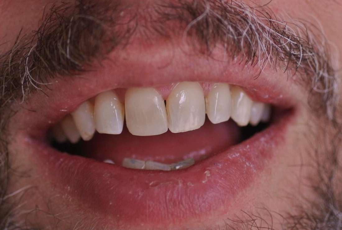 complete smile after cosmetic dentistry | cosmetic dentist st paul mn