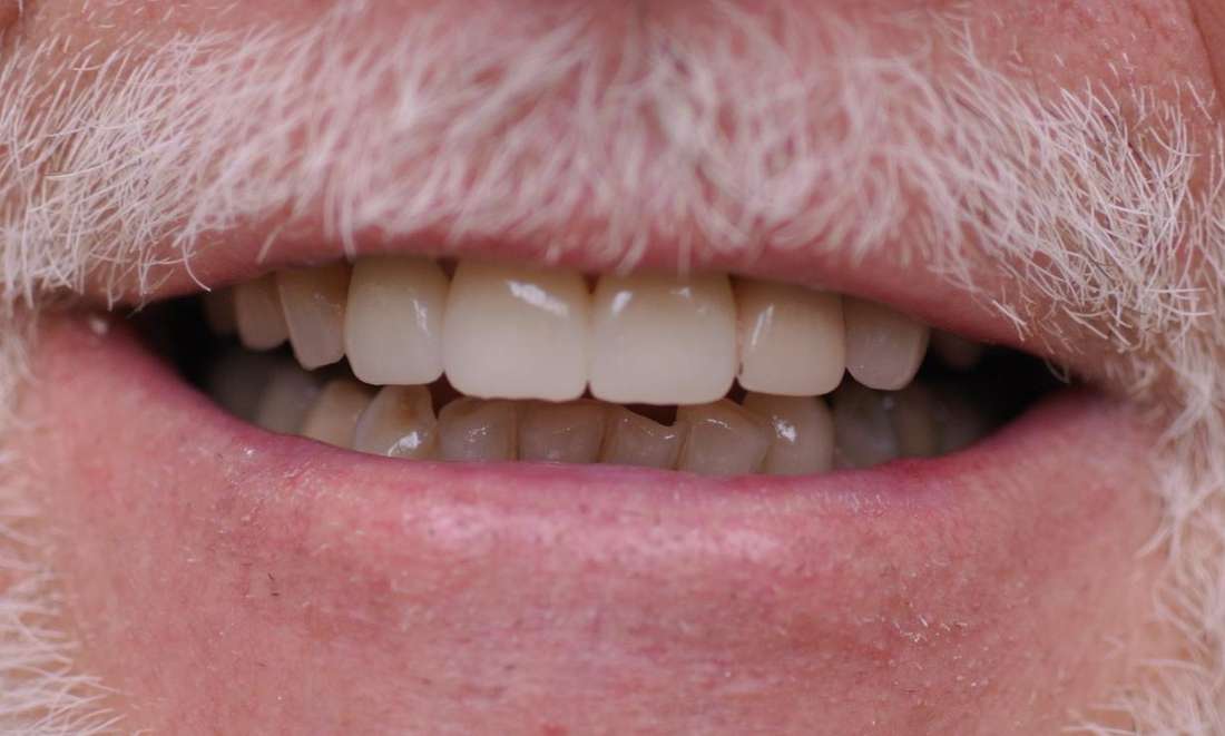 complete smile after dental crowns | dentist st paul mn