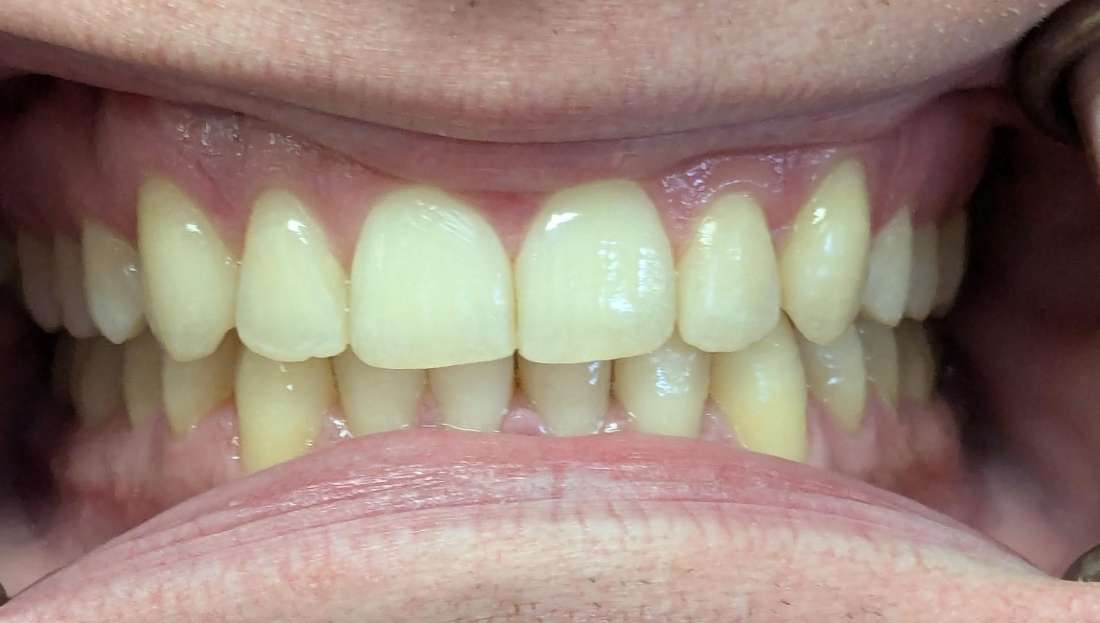 Close up of mouth after clear aligners, st paul mn