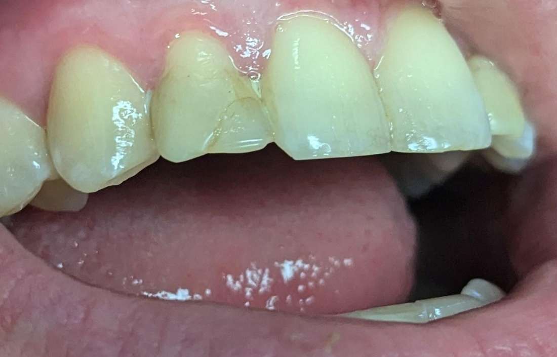 cosmetic dentistry st paul before photo