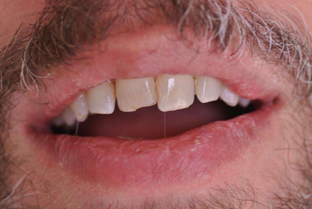 saint paul cosmetic dentistry- before photo | dentist st paul