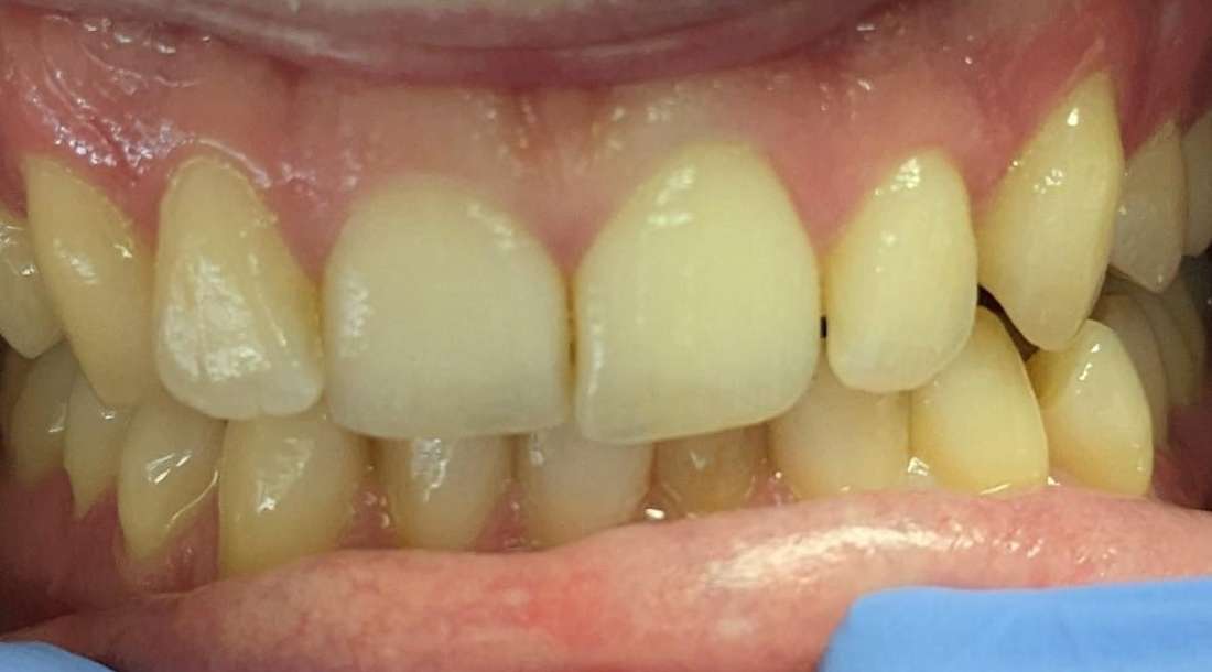 clear aligners st paul- before photo
