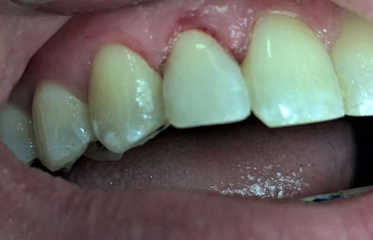 cosmetic dentistry st paul after photo