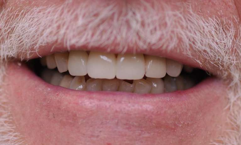 Gain-Confidence-With-Smile-Makeovers-After-Image