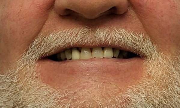Gain-Confidence-With-Smile-Makeovers-Before-Image